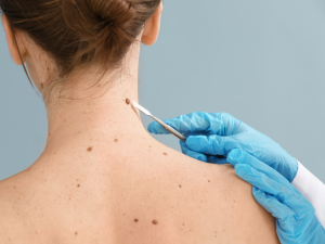 Tratamiento de un melanoma